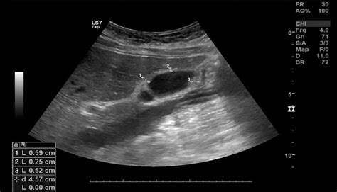 normal gallbladder wall thickness ultrasound